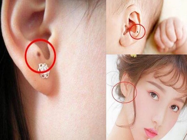Xem bói nốt ruồi ở mặt, nốt ruồi ở tai