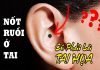 Xem bói nốt ruồi ở tai đoán vận mệnh, tính cách con người
