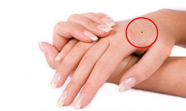 Nốt ruồi trên mu bàn tay